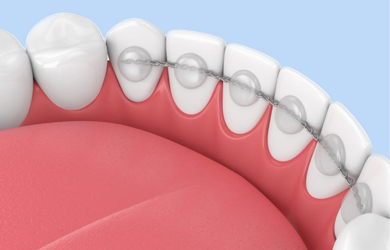 A 3 D Rendering Of Fixed Retainers