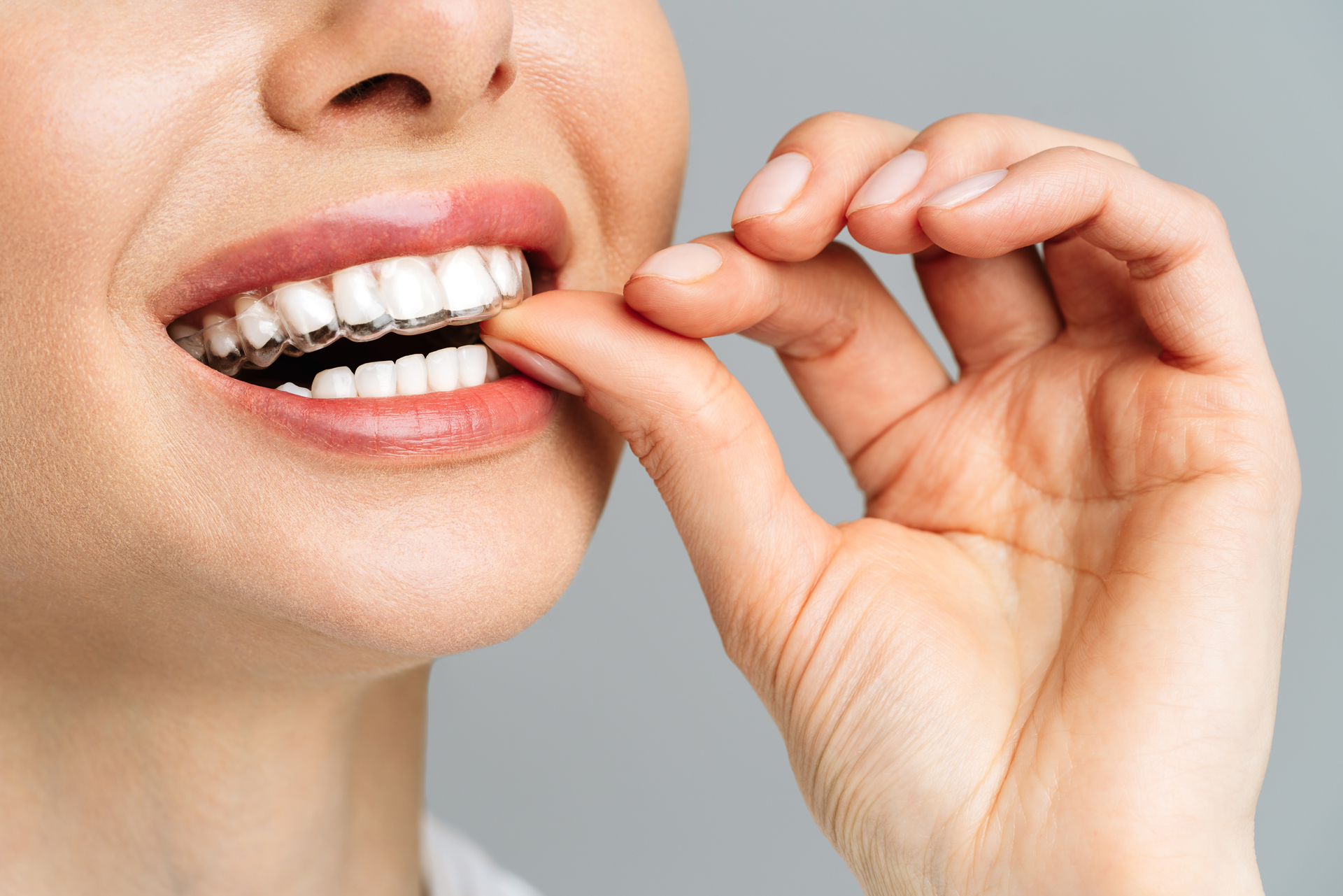 A Young Woman Does A Home Teeth Whitening Procedure